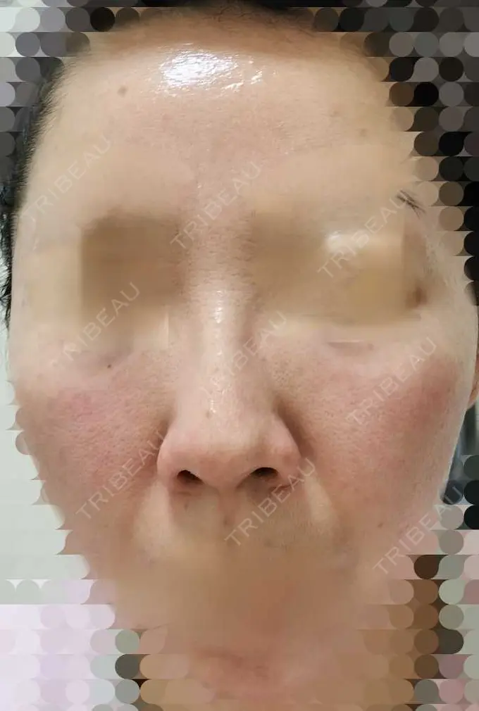 ルメッカ ルラ美容クリニック 神戸院 AFTER メイン用