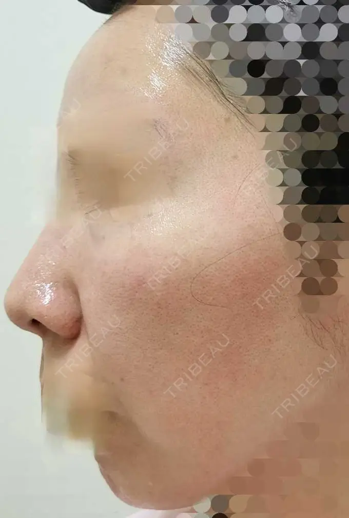 ルメッカ ルラ美容クリニック 神戸院 DAY 11 メイン用