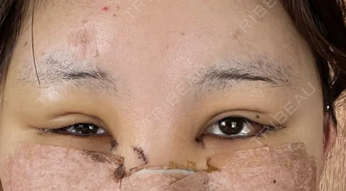 クマ治療 / 目尻切開 / タレ目形成・グラマラスライン（切開） R Beauty CLINIC 銀座院 DAY 6 メイン用