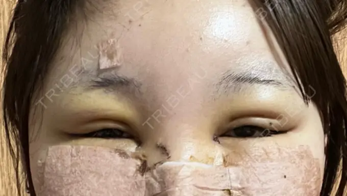 クマ治療 / 目尻切開 / タレ目形成・グラマラスライン（切開） R Beauty CLINIC 銀座院 DAY 7 メイン用