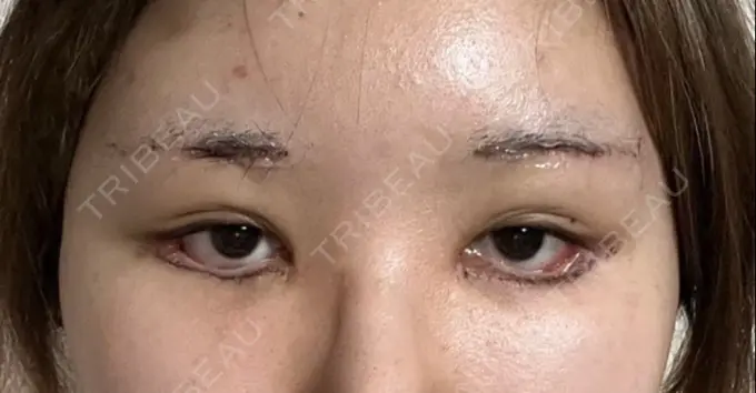 クマ治療 / 目尻切開 / タレ目形成・グラマラスライン（切開） R Beauty CLINIC 銀座院 DAY 13 メイン用