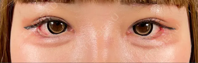 クマ治療 / 目尻切開 / タレ目形成・グラマラスライン（切開） R Beauty CLINIC 銀座院 DAY 65 メイン用