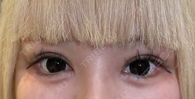 クマ治療 / 目尻切開 / タレ目形成・グラマラスライン（切開） R Beauty CLINIC 銀座院 AFTER メイン用