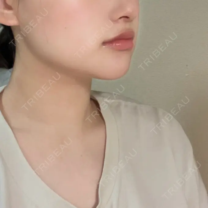 糸リフト / 脂肪吸引（顔） 東京シンデレラ美容外科 大宮院 DAY 28 メイン用