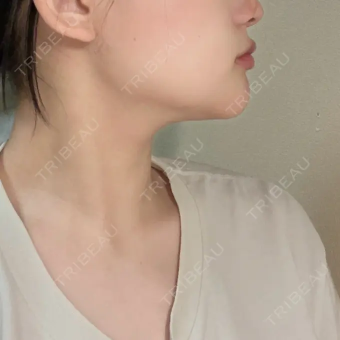 糸リフト / 脂肪吸引（顔） 東京シンデレラ美容外科 大宮院 DAY 28 メイン用