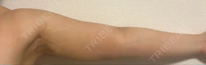 脂肪吸引（二の腕） ルーチェクリニック 銀座院 DAY 11 メイン用