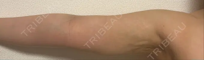 脂肪吸引（二の腕） ルーチェクリニック 銀座院 DAY 11 メイン用