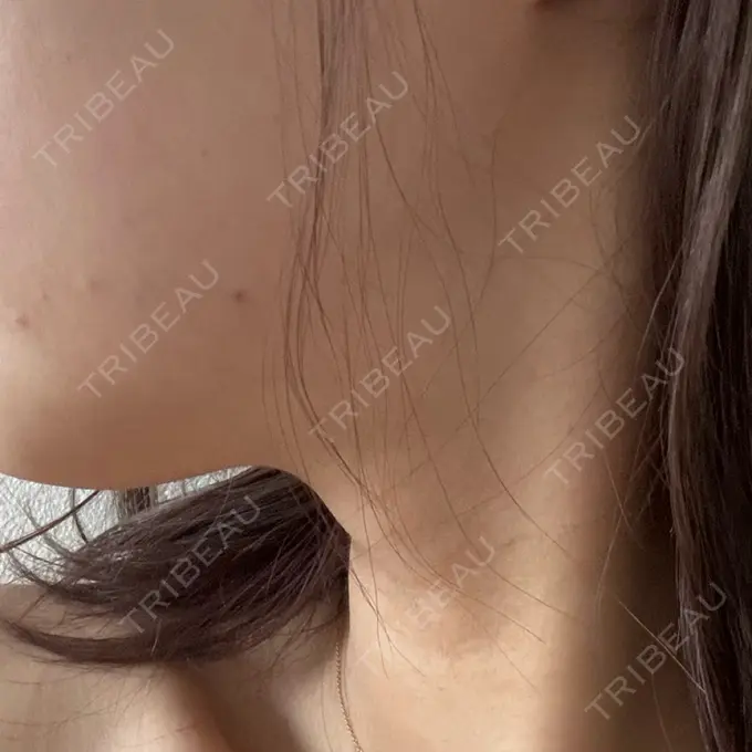 ボトックス（エラ・小顔） TCB東京中央美容外科 豊橋院 DAY 1 メイン用