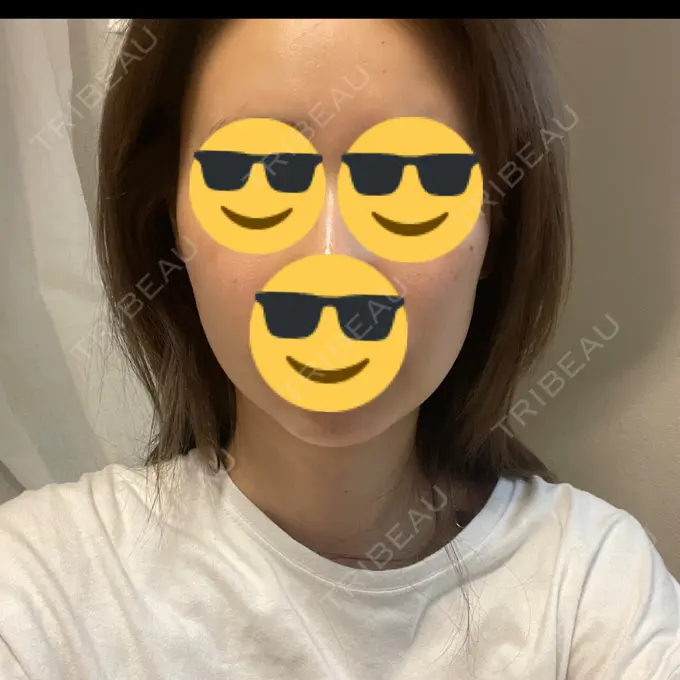 脂肪溶解注射（顔） 表参道ウィズ・クリニック AFTER メイン用