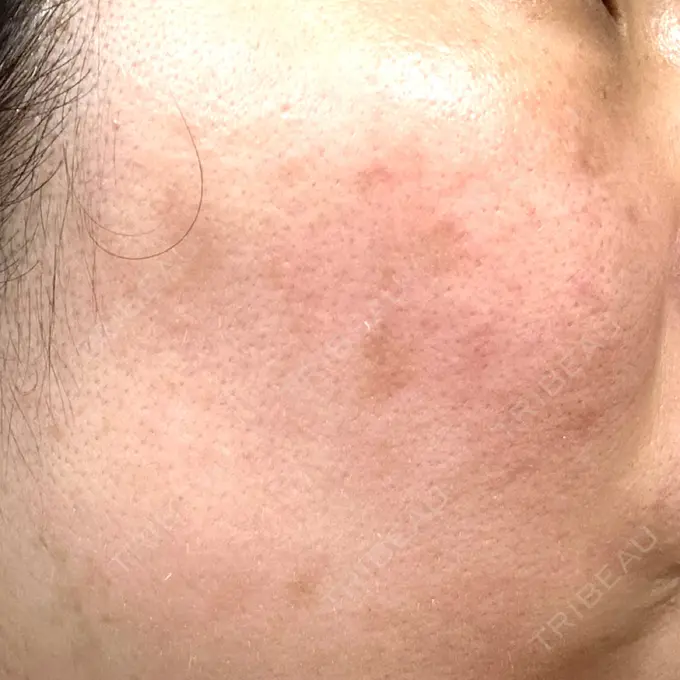 その他（肌） / ピコレーザートーニング（美白・肝斑） SK新宿歌舞伎町美容外科・歯科 DAY 6 メイン用