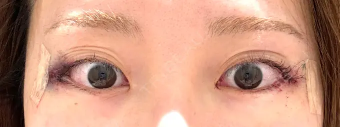 目尻切開 / 目尻靭帯移動 S.T styleクリニック DAY 0 メイン用