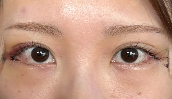 目尻切開 / 目尻靭帯移動 S.T styleクリニック DAY 2 メイン用