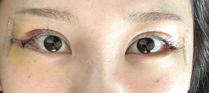 目尻切開 / 目尻靭帯移動 S.T styleクリニック DAY 6 メイン用