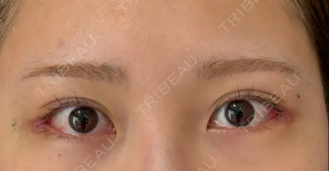 目尻切開 / 目尻靭帯移動 S.T styleクリニック DAY 10 メイン用