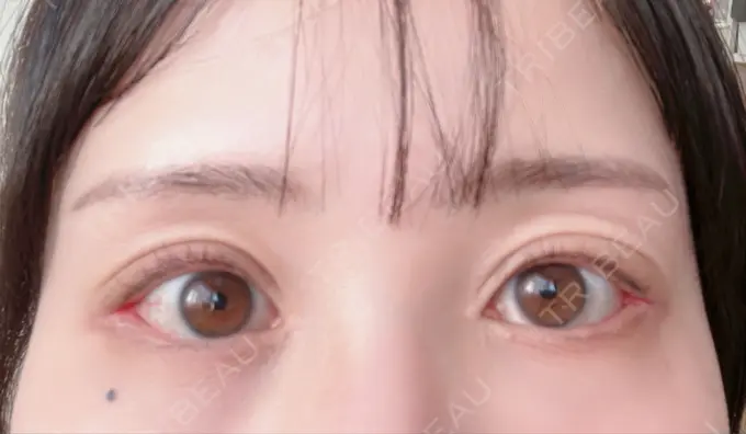 目尻靭帯移動 アネシス美容クリニック DAY 9 メイン用