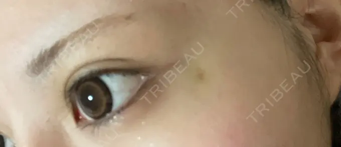 ボトックス（タレ目） 新宿TAクリニック DAY 3 メイン用