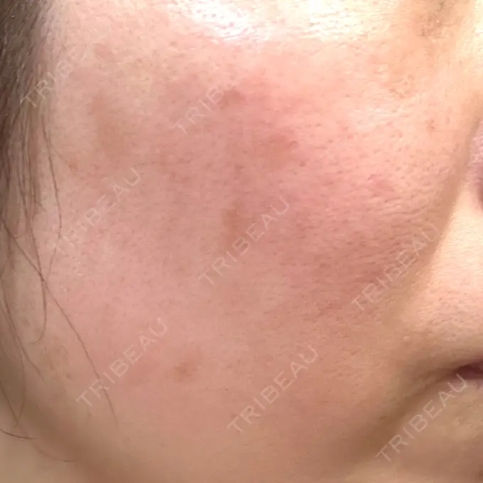 その他（肌） / ピコレーザートーニング（美白・肝斑） SK新宿歌舞伎町美容外科・歯科 DAY 7 メイン用