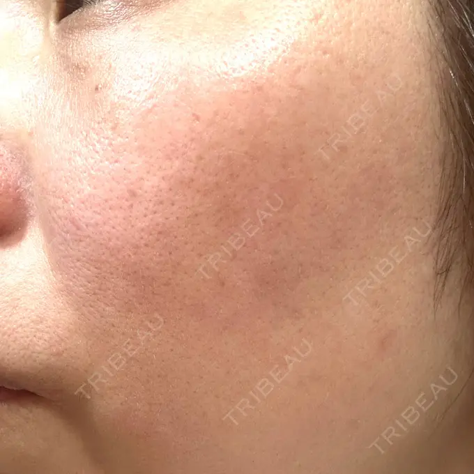 その他（肌） / ピコレーザートーニング（美白・肝斑） SK新宿歌舞伎町美容外科・歯科 DAY 7 メイン用