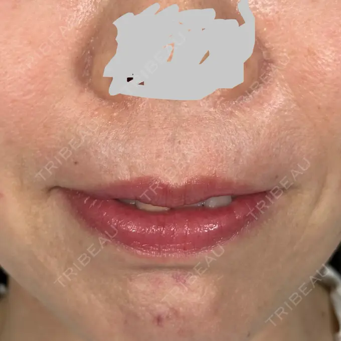 肌ヒアルロン酸注入（たるみ・シワ改善） アリエル美容クリニック 大宮院 DAY 0 メイン用