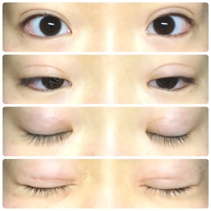 二重埋没 湘南美容クリニック 新宿本院 DAY 15 メイン用