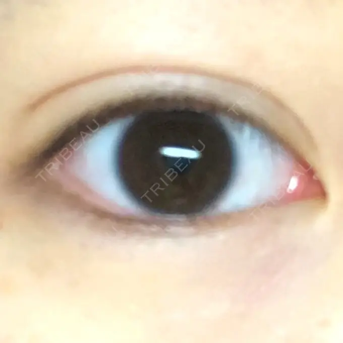 二重埋没 湘南美容クリニック 新宿本院 DAY 15 メイン用