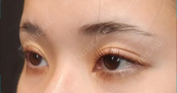 クマ治療 / 目尻切開 / 下まぶたたるみ取り / 下まぶたの脂肪取り / タレ目形成・グラマラスライン（切開） Tokyo Tensei Clinic 新宿院 AFTER メイン用