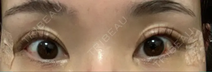 クマ治療 / 目尻切開 / 下まぶたたるみ取り / 下まぶたの脂肪取り / タレ目形成・グラマラスライン（切開） Tokyo Tensei Clinic 新宿院 DAY 2 メイン用