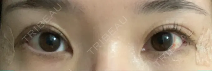 クマ治療 / 目尻切開 / 下まぶたたるみ取り / 下まぶたの脂肪取り / タレ目形成・グラマラスライン（切開） Tokyo Tensei Clinic 新宿院 DAY 2 メイン用