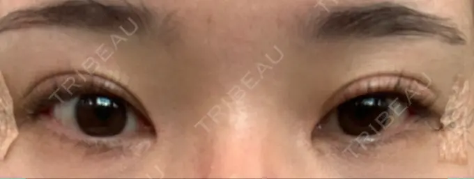 クマ治療 / 目尻切開 / 下まぶたたるみ取り / 下まぶたの脂肪取り / タレ目形成・グラマラスライン（切開） Tokyo Tensei Clinic 新宿院 DAY 4 メイン用