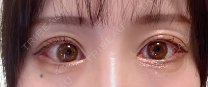 目尻靭帯移動 アネシス美容クリニック DAY 11 メイン用