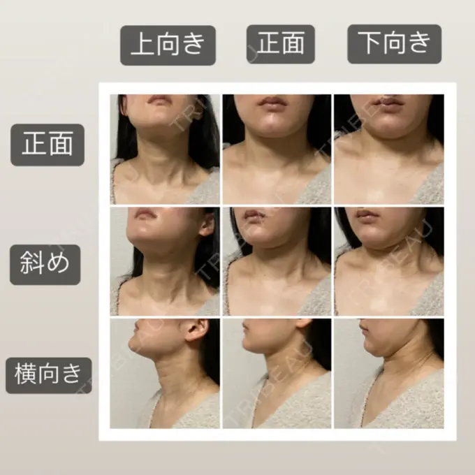 脂肪吸引（顔） 湘南美容クリニック 秋葉原院 DAY 35 メイン用