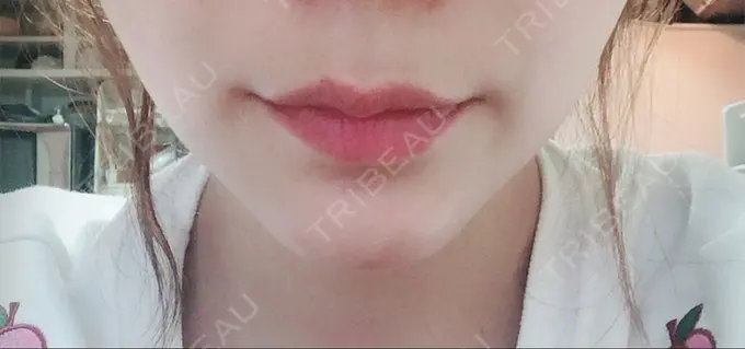 あごプロテーゼ ジュエリー美容外科 DAY 16 メイン用