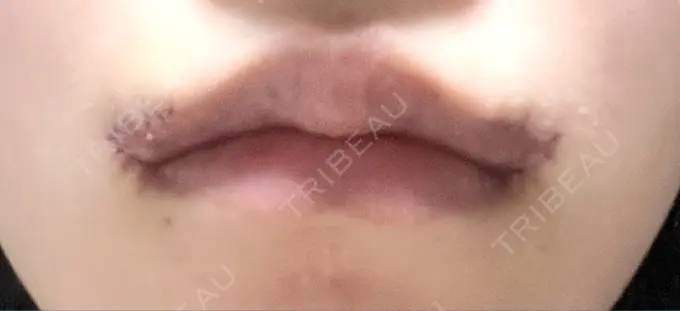 口角挙上 くさのたろうクリニック DAY 7 メイン用