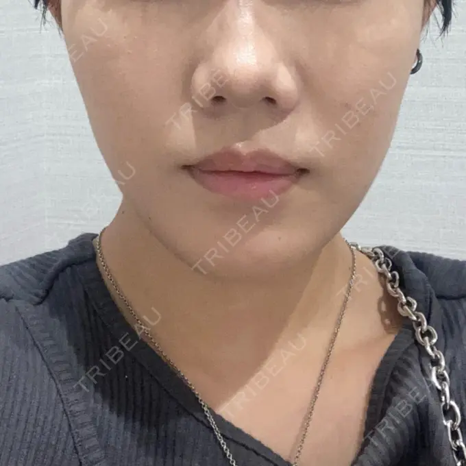 バッカルファット除去 / 脂肪吸引（顔） / メーラーファット除去 R Beauty CLINIC 名古屋院 DAY 33 メイン用