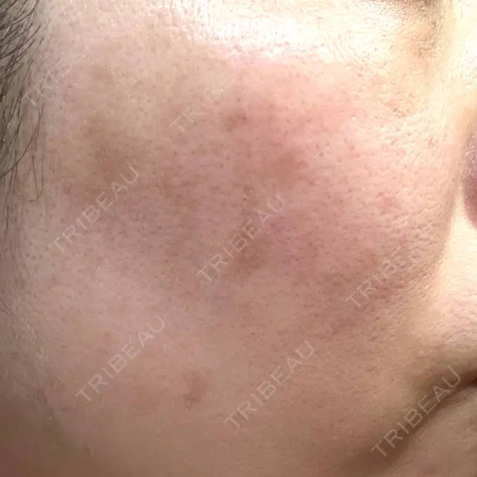 その他（肌） / ピコレーザートーニング（美白・肝斑） SK新宿歌舞伎町美容外科・歯科 DAY 8 メイン用