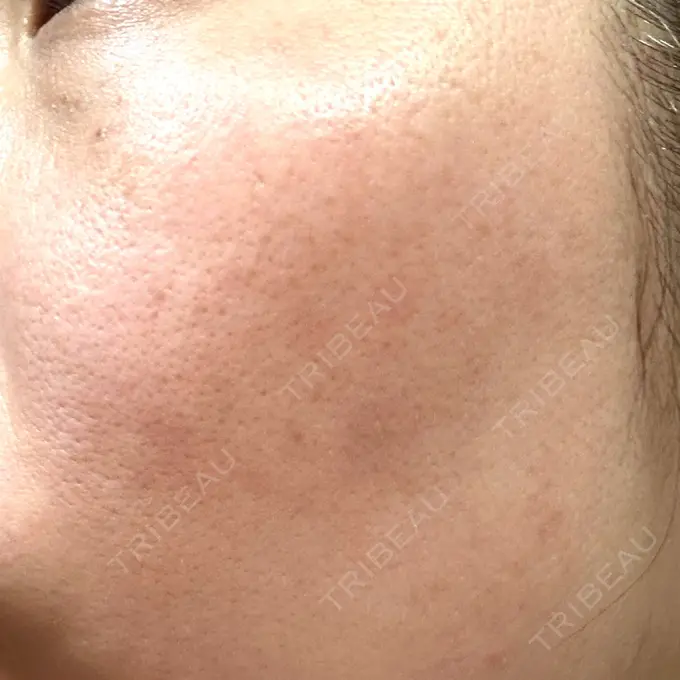 その他（肌） / ピコレーザートーニング（美白・肝斑） SK新宿歌舞伎町美容外科・歯科 DAY 8 メイン用