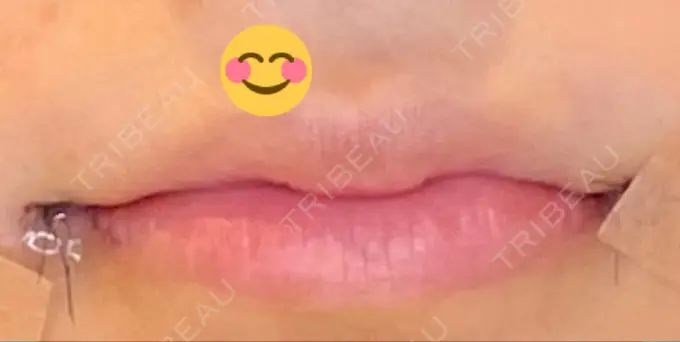 口角挙上 LOUIS CLINIC 二子玉川院【ルイクリニック】 DAY 0 メイン用