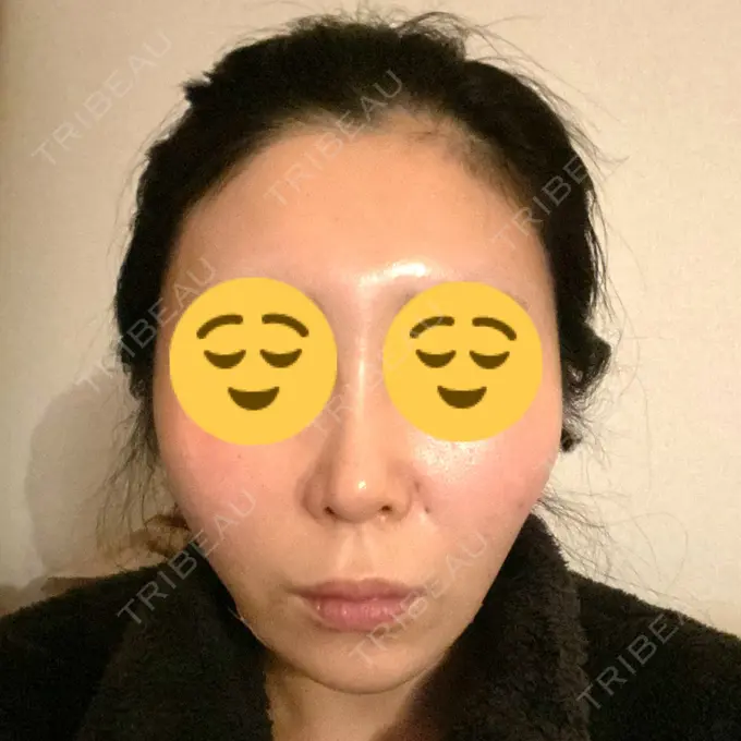 糸リフト 横浜TAクリニック DAY 0 メイン用