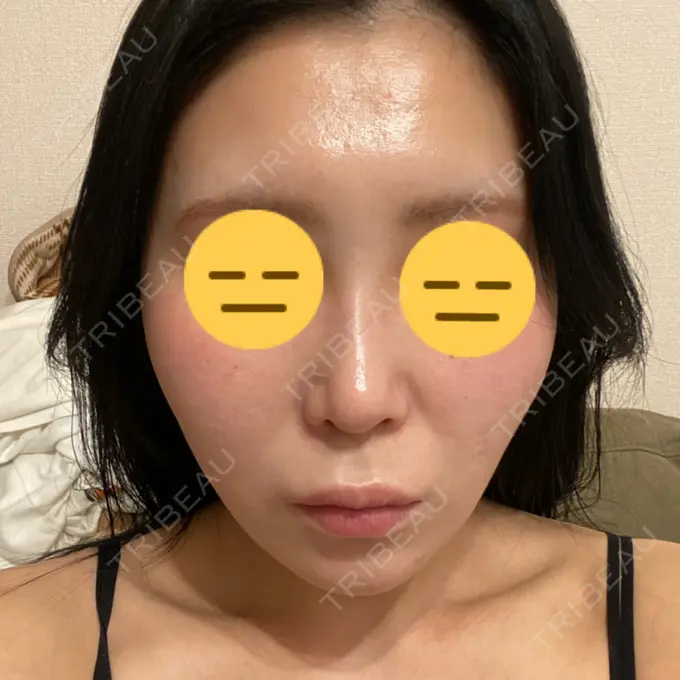 糸リフト 横浜TAクリニック AFTER メイン用