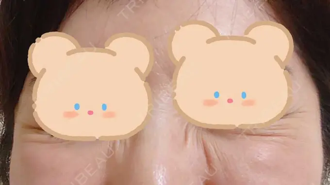 シワ取りボトックス / ボトックス（目尻） 湘南美容クリニック 川崎院 DAY 2 メイン用