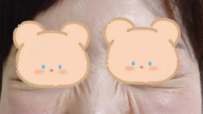 シワ取りボトックス / ボトックス（目尻） 湘南美容クリニック 川崎院 DAY 3 メイン用