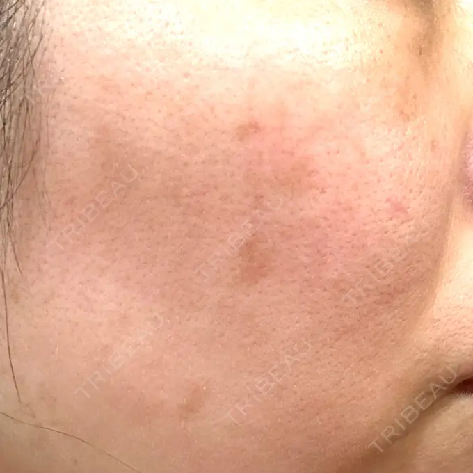 その他（肌） / ピコレーザートーニング（美白・肝斑） SK新宿歌舞伎町美容外科・歯科 DAY 10 メイン用