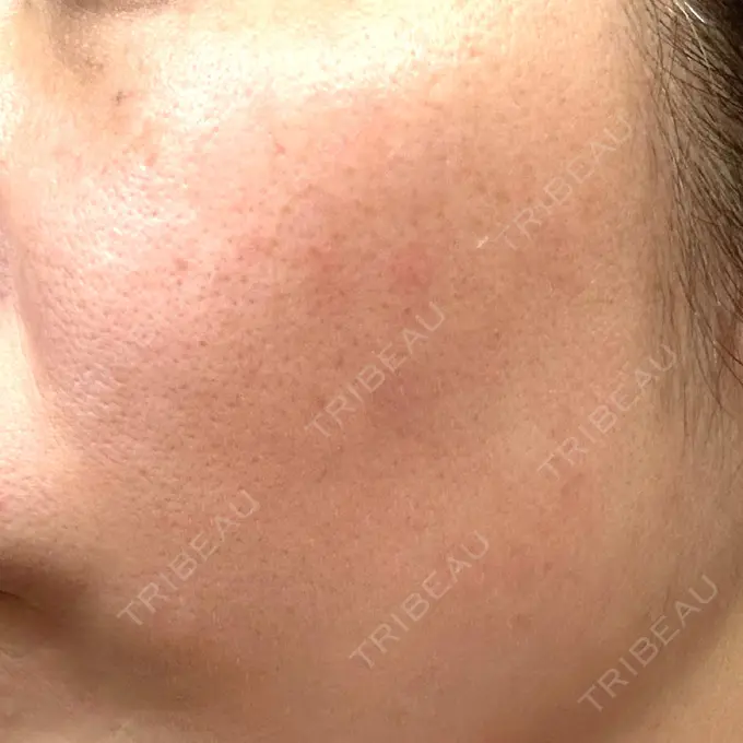 その他（肌） / ピコレーザートーニング（美白・肝斑） SK新宿歌舞伎町美容外科・歯科 DAY 10 メイン用