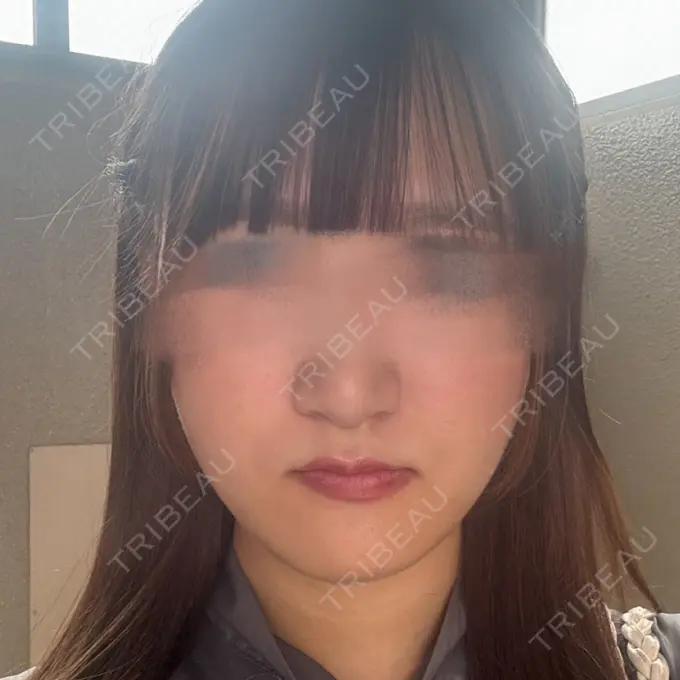 骨切り（あご） 銀座マイアミ美容外科 DAY 62 メイン用