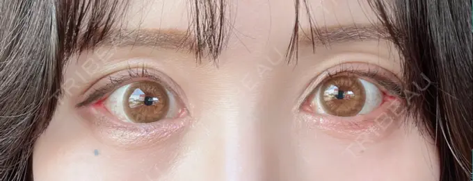 目尻靭帯移動 アネシス美容クリニック DAY 13 メイン用