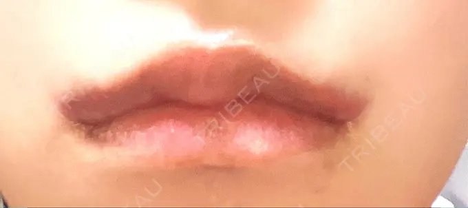 口角挙上 くさのたろうクリニック DAY 8 メイン用