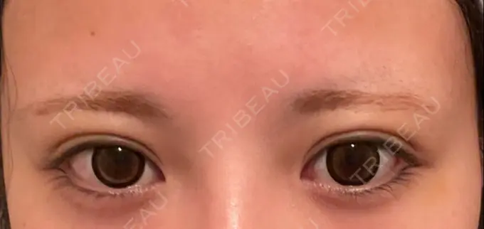 ボトックス（タレ目） 新宿TAクリニック DAY 7 メイン用