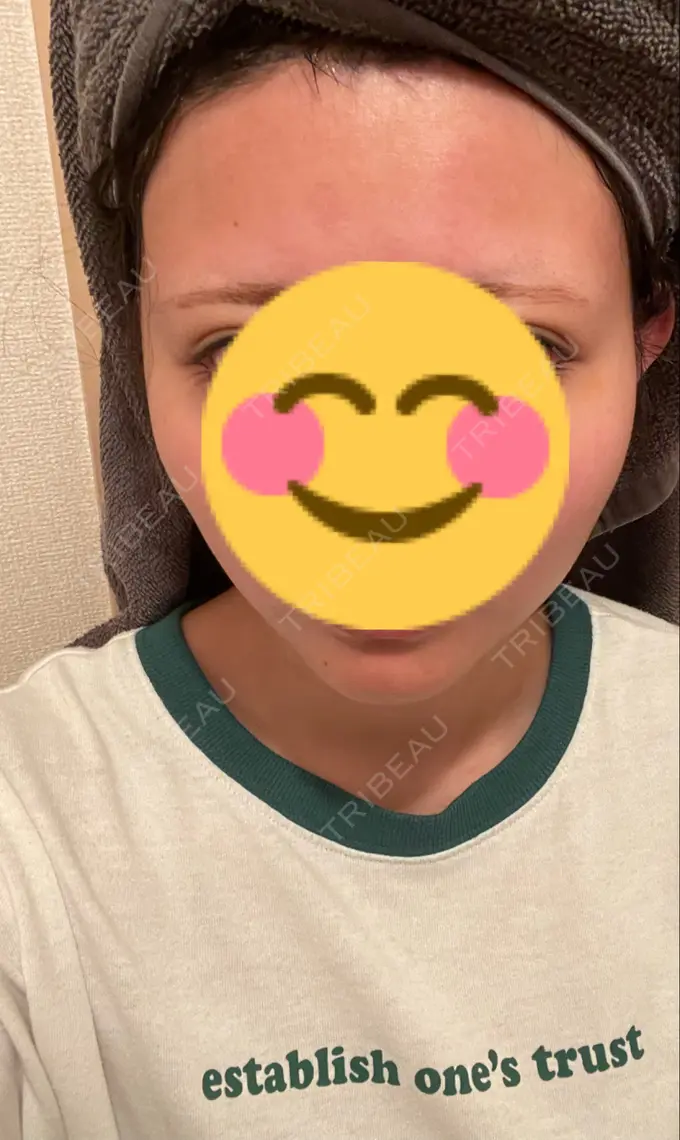 ボトックス（エラ・小顔） ビューティースキンクリニック 渋谷院 DAY 7 メイン用