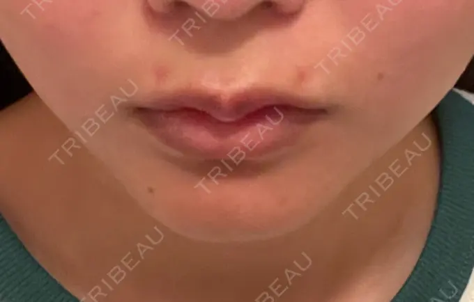 ヒアルロン酸注入（唇） / ボトックス（口角） ルラ美容クリニック 渋谷本院 DAY 7 メイン用