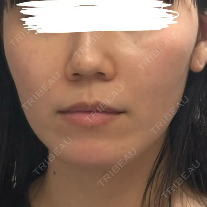 糸リフト / ヒアルロン酸注入（鼻翼基部） 吉祥寺アイビークリニック DAY 1 メイン用